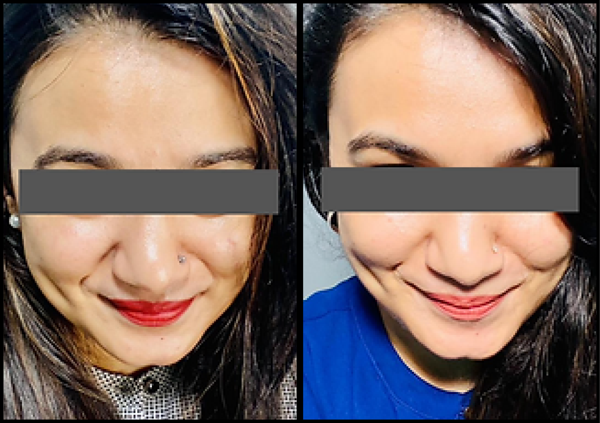 In just one week, we observed a transformative facial rejuvenation with a sculpted jawline, de-puffed face, and smoother nasolabial folds. Say goodbye to a double chin and hello to a more radiant, confident you!