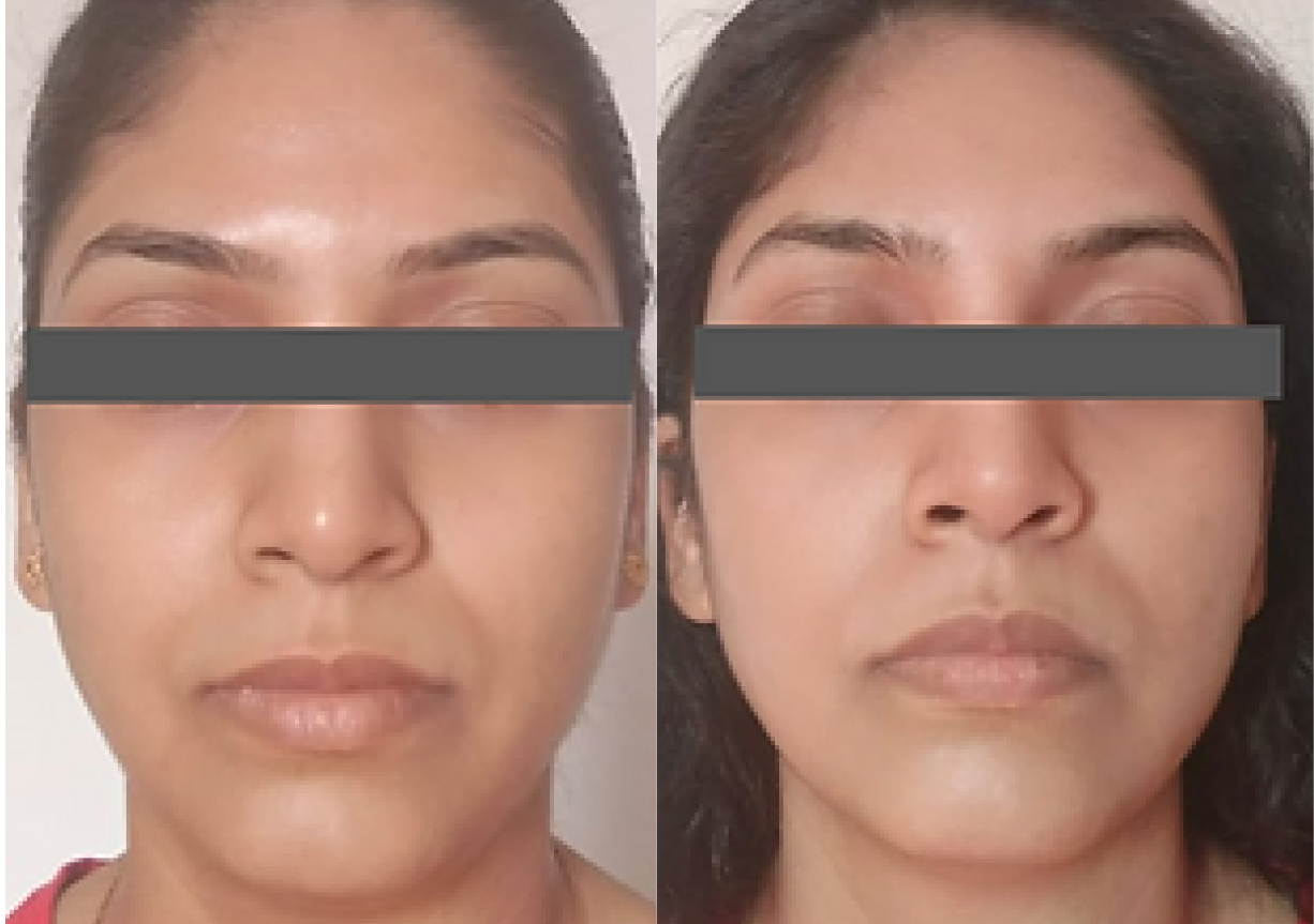 In just one week, we observed a transformative facial rejuvenation with a sculpted jawline, de-puffed face, and smoother nasolabial folds. Say goodbye to a double chin and hello to a more radiant, confident you!