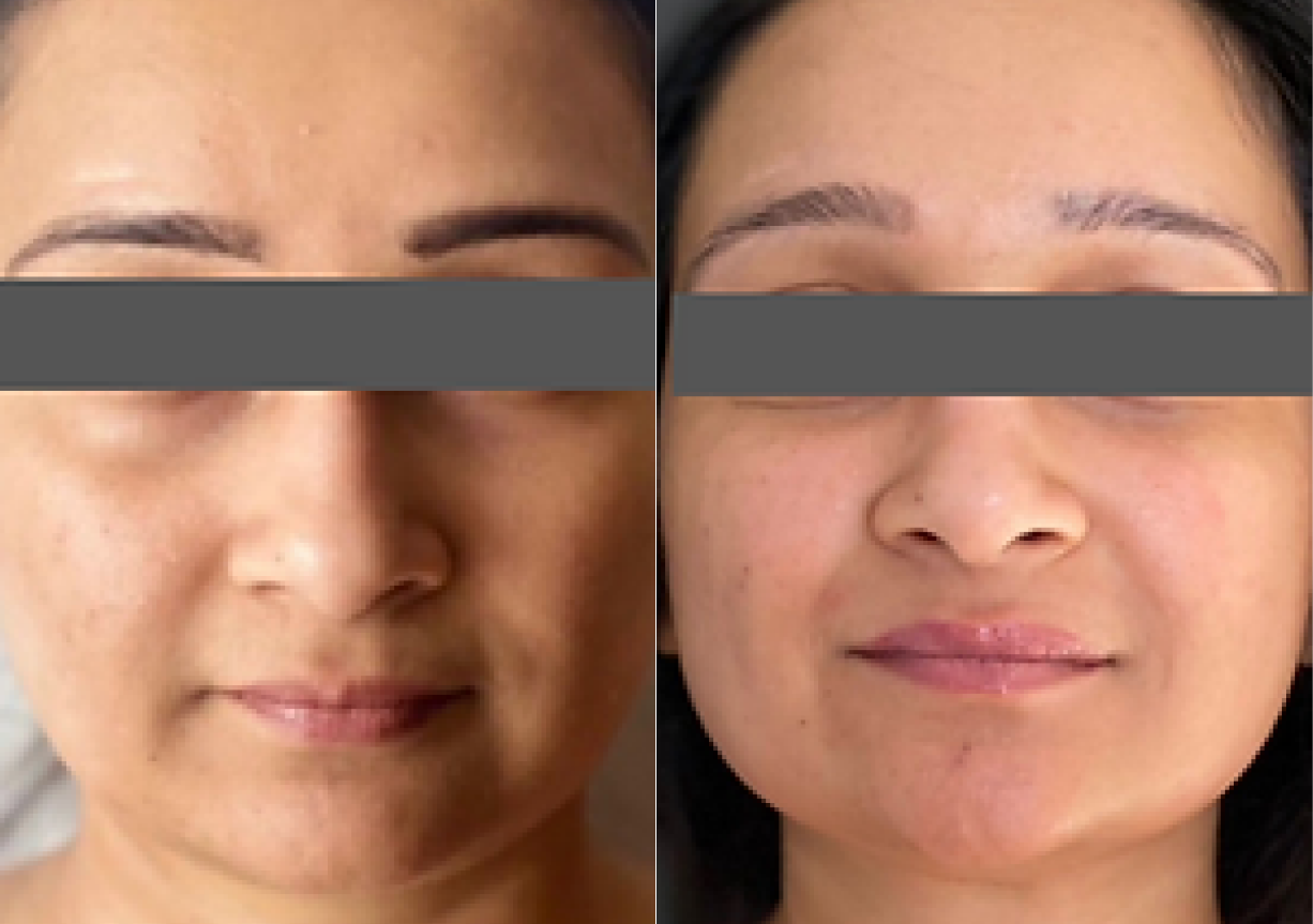 In just one week, we observed a transformative facial rejuvenation with a sculpted jawline, de-puffed face, and smoother nasolabial folds. Say goodbye to a double chin and hello to a more radiant, confident you!