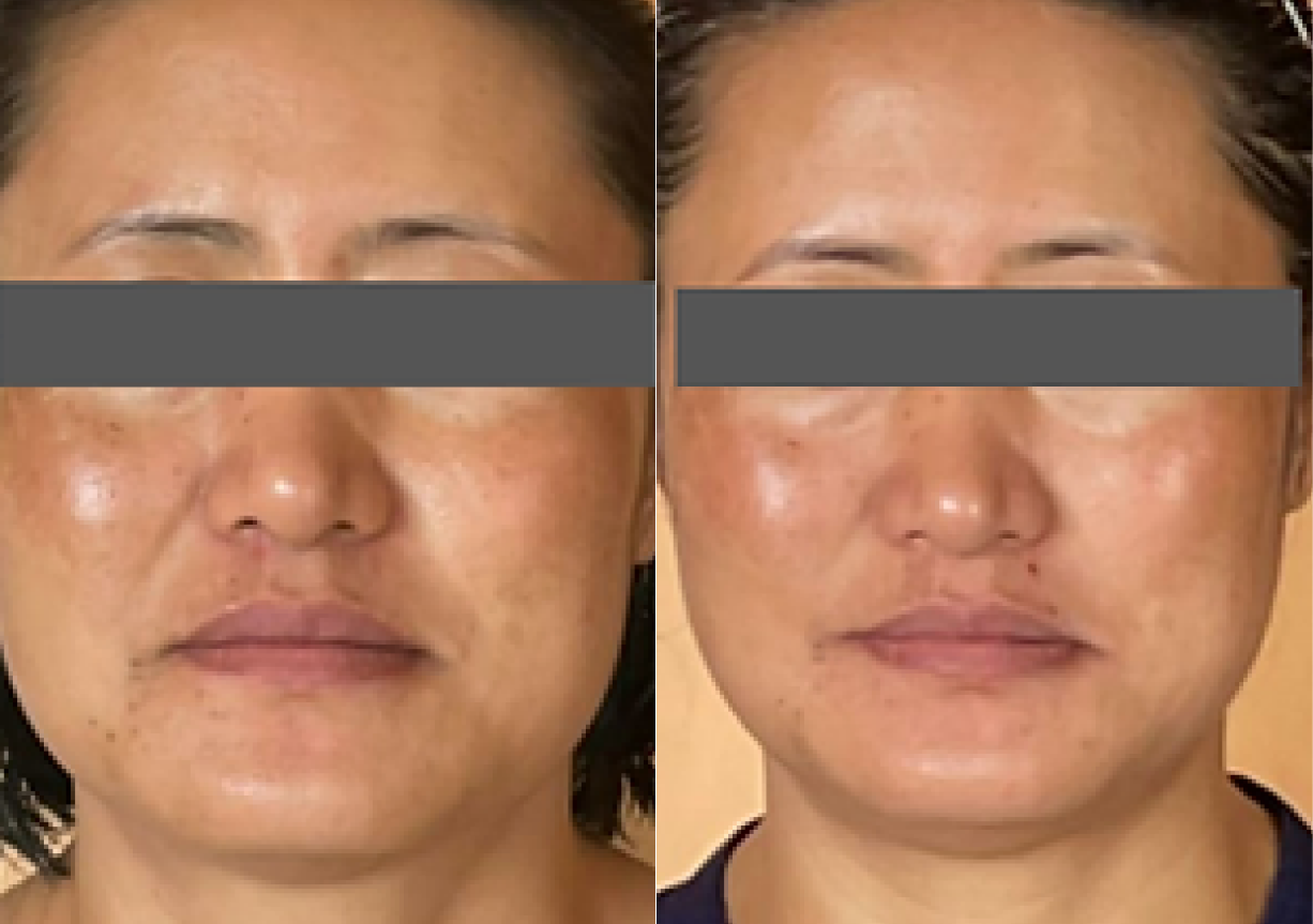 In just one week, we observed a transformative facial rejuvenation with a sculpted jawline, de-puffed face, and smoother nasolabial folds. Say goodbye to a double chin and hello to a more radiant, confident you!