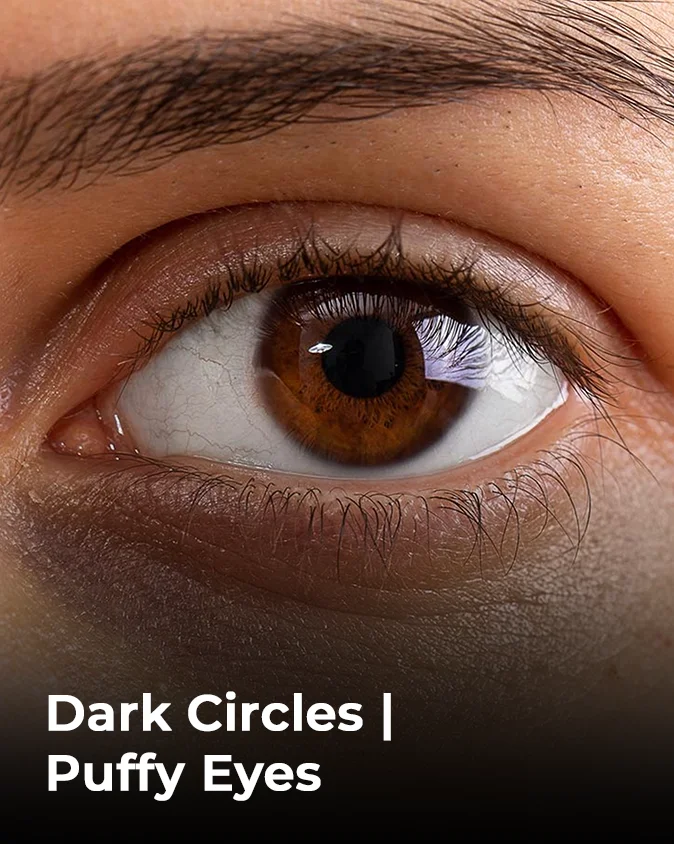 Dark Circles Puffy Eyes