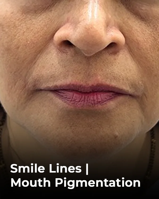 Marionette Lines Thin Lips Droopy Mouth