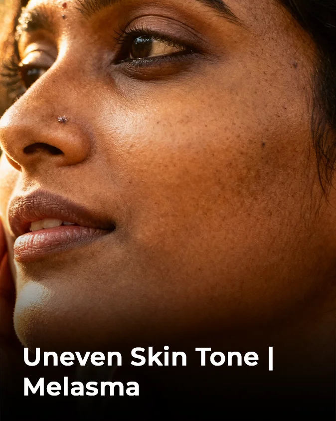 Pigmentation Uneven Skin Tone Melasma